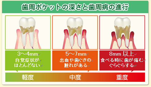 歯の話４2 今さら聞けない 歯周ポケットの基礎知識 医療法人白山歯科クリニック 小田原市足柄駅徒歩3分の歯医者