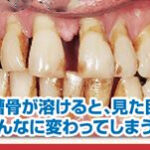 歯周病の本当の怖さ１-1